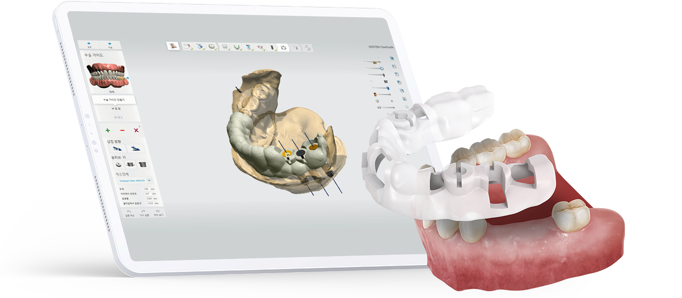 첨단 디지털 장비를 이용한 임플란트