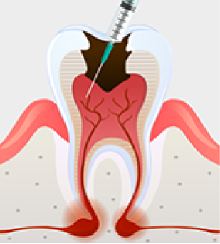 신경 경로 확보