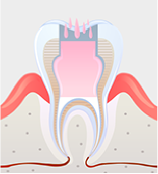 신경관에 충전재 삽입