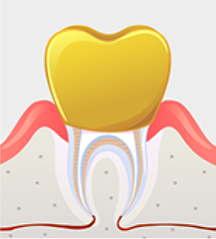 보철물로 치아 윗부분 마무리