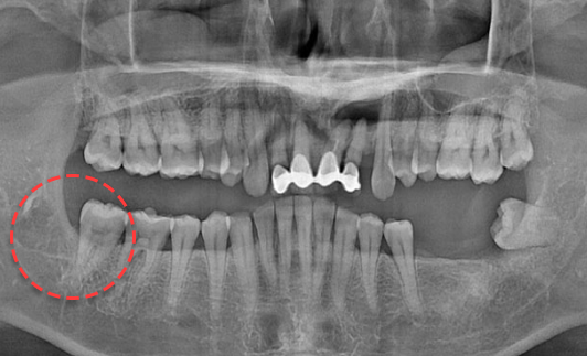 오른쪽 하악 매복 사랑니 발치 After X-Ray