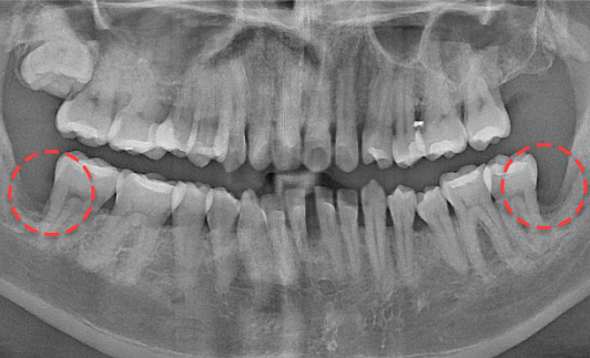 양쪽 하악 매복 사랑니 발치 After X-Ray