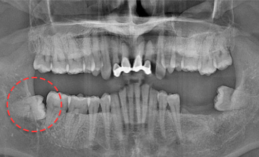 오른쪽 하악 매복 사랑니 발치 Before X-Ray