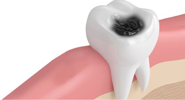 사랑니 발치 이유 1