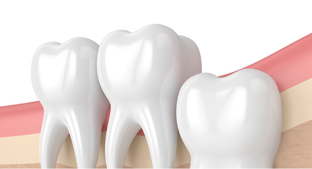 사랑니 발치 이유 2