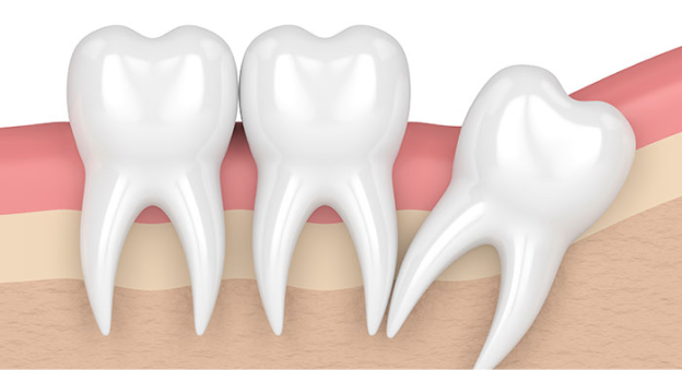 사랑니 발치 이유 3