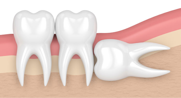 사랑니 발치 이유 4